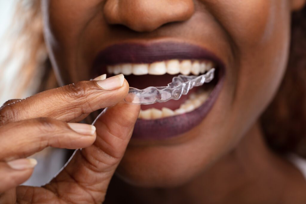 Invisalign in Groesbeck, TX