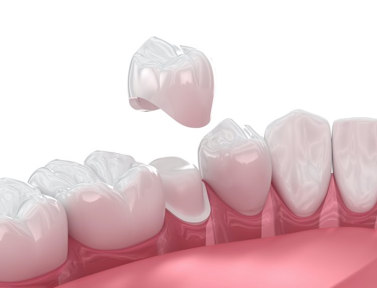 Understanding when dentists recommend dental crowns can guide patients in making informed decisions about their oral health.