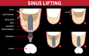 Sinus Lift Groesbeck Texas